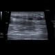 Baker's cyst, rupture: US - Ultrasound